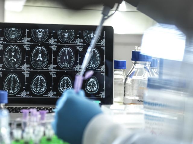 Test zatwierdzony przez FDA pomoże w diagnozie choroby Alzheimera we wczesnym stadium