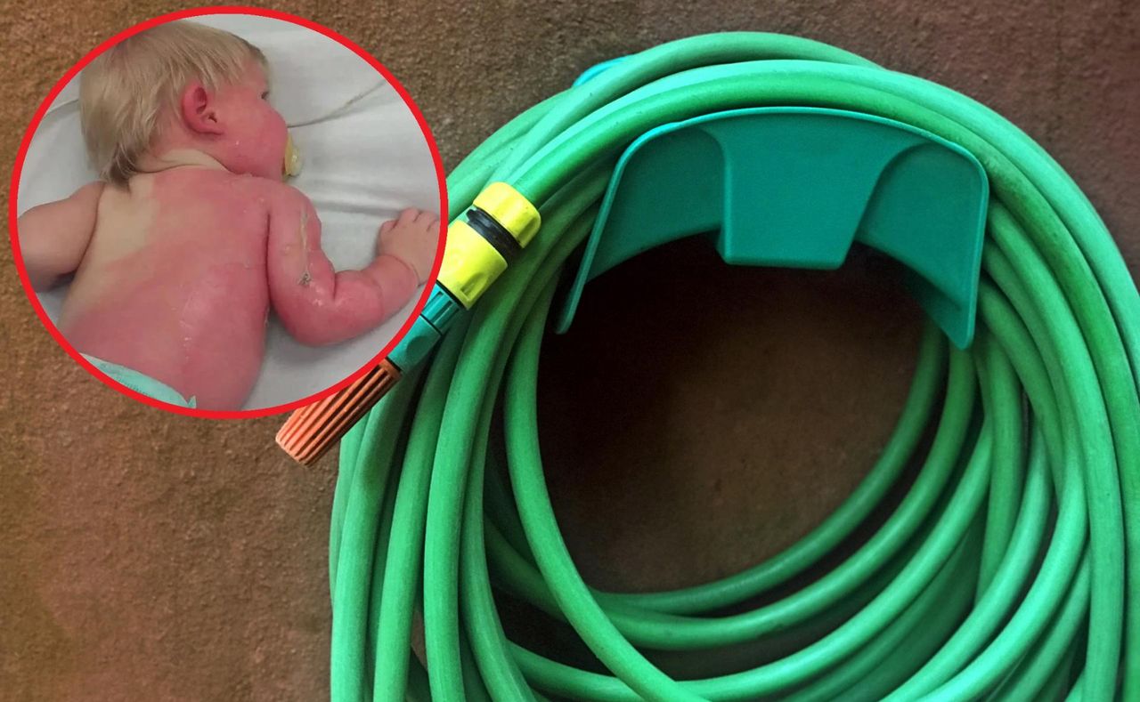 Mama poparzyła dziecko. Niebezpieczna zabawa z wężem ogrodowym