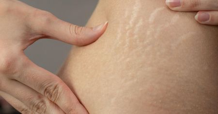 Rozstępy zaczynają się od środka. Co jeść, żeby skóra nie pękała?