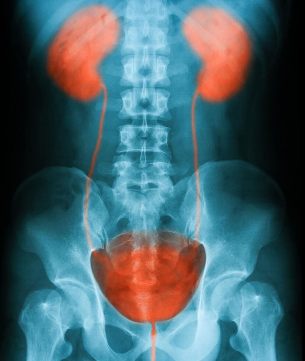 Urografia to badanie RTG z kontrastem układu moczowego 