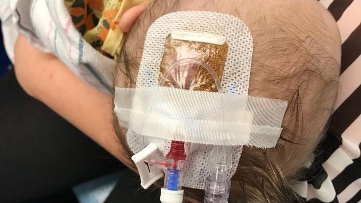 Dziewczynka została zarażona groźnym wirusem