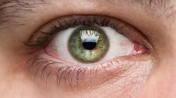 Groźne grudki na powiekach. Mogą zwiastować zawał