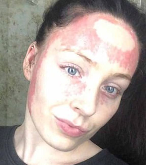 Briseis Lunn choruje na łuszczycę.