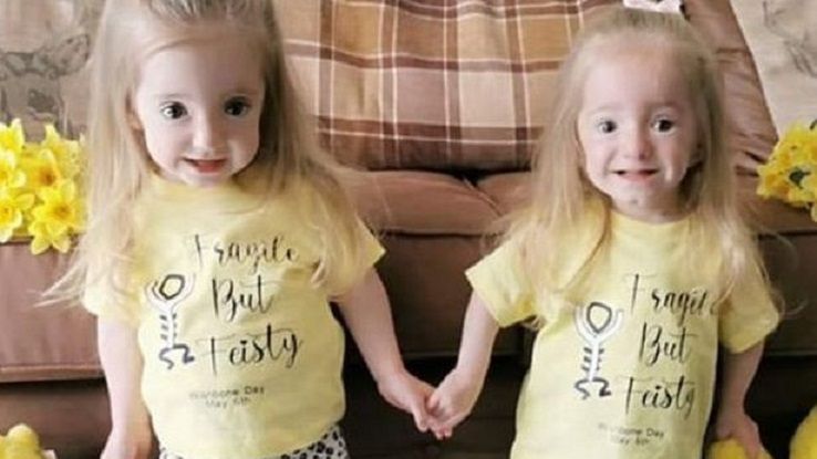 Bliźnięta z rzadką wadą genetyczną