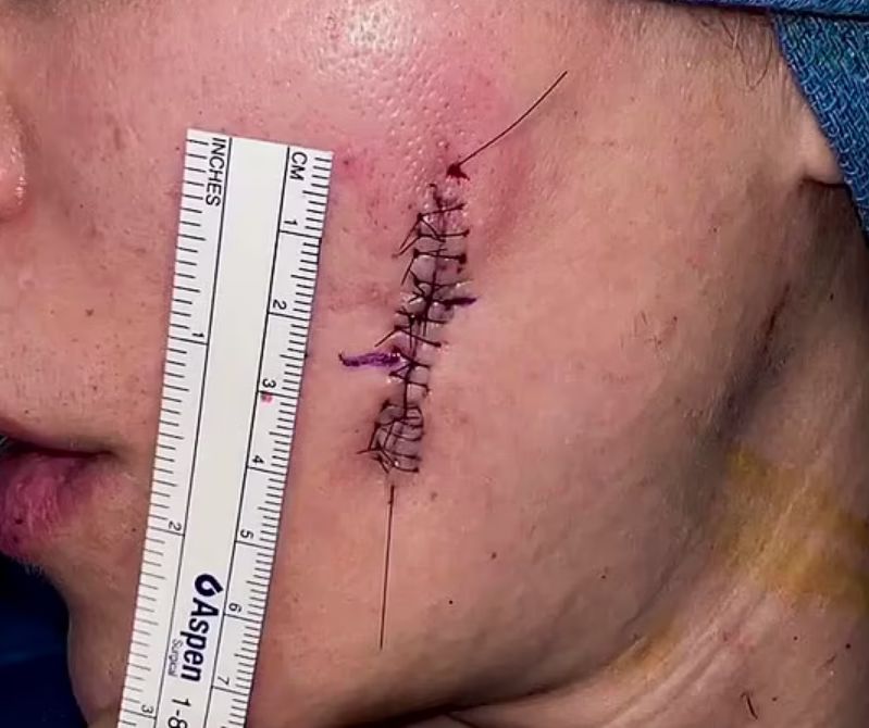 Guz u celebrytki miał 4 centymetry długości