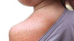 Trzydniówka u dzieci - przyczyny, objawy i leczenie