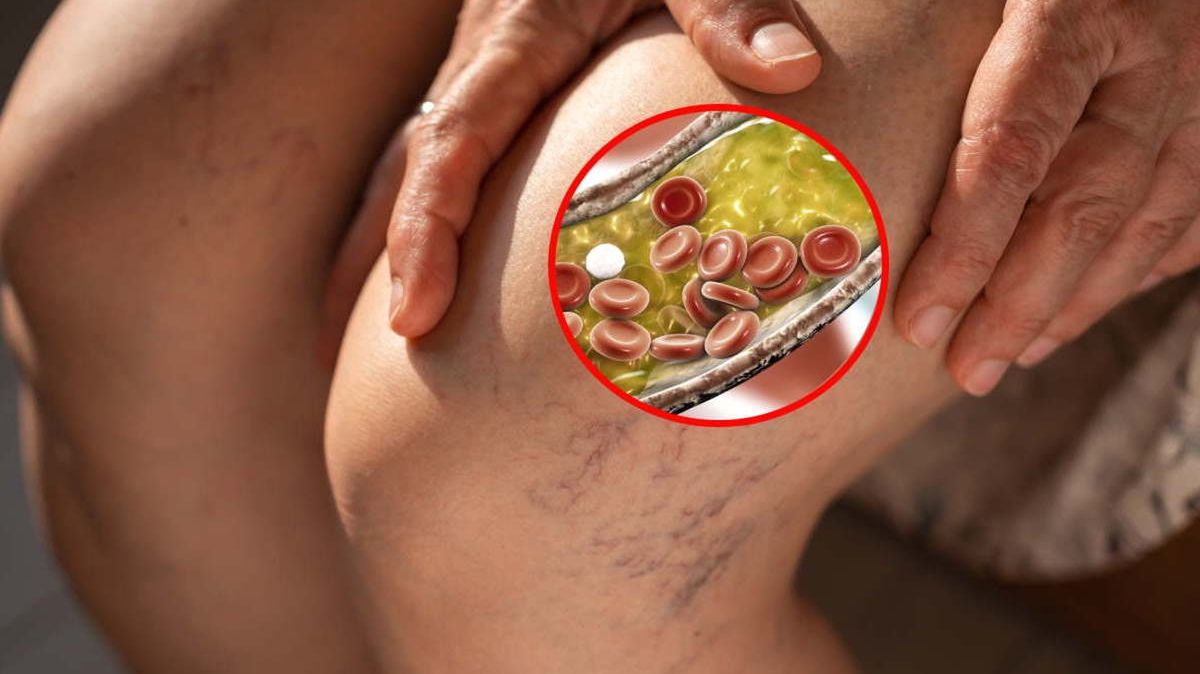 Sygnał, że twoje żyły są zapchane. Siedem zaskakujących objawów