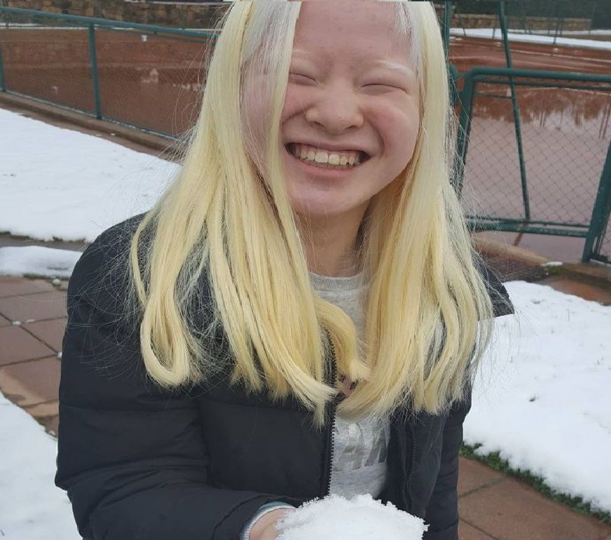 Modelka z albinizmem 