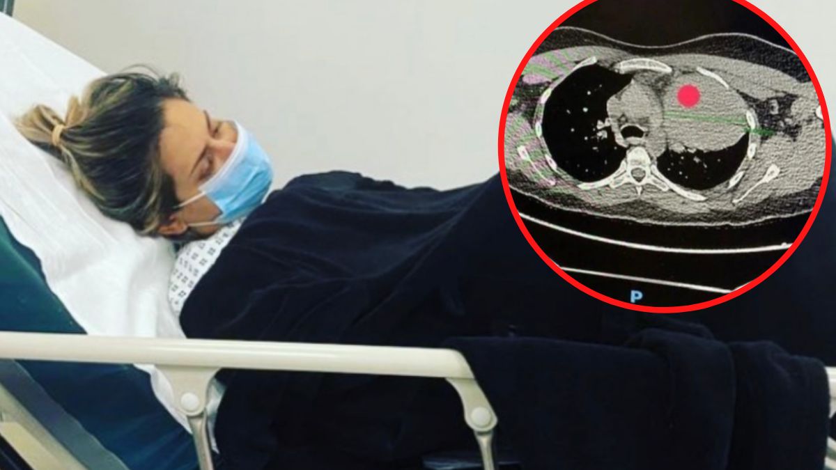 Nie rozpoznali rzadkiego nowotworu, dopóki nie pojawiły się przerzuty. Jeden z nich ma wielkość mandarynki i rośnie obok serca