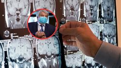 Zbadali mózgi osób po udarze. Ustalili, co do niego doprowadziło