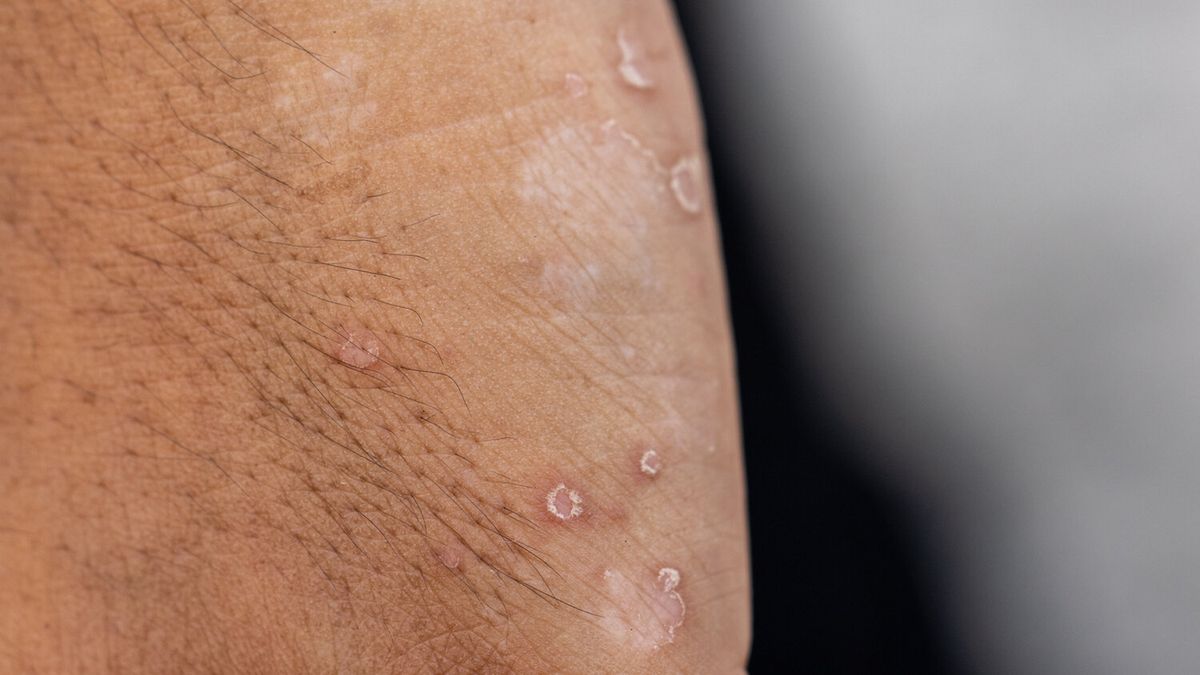 Naukowcy powiązali toczeń z wirusem, którego nosicielem jest prawie każdy