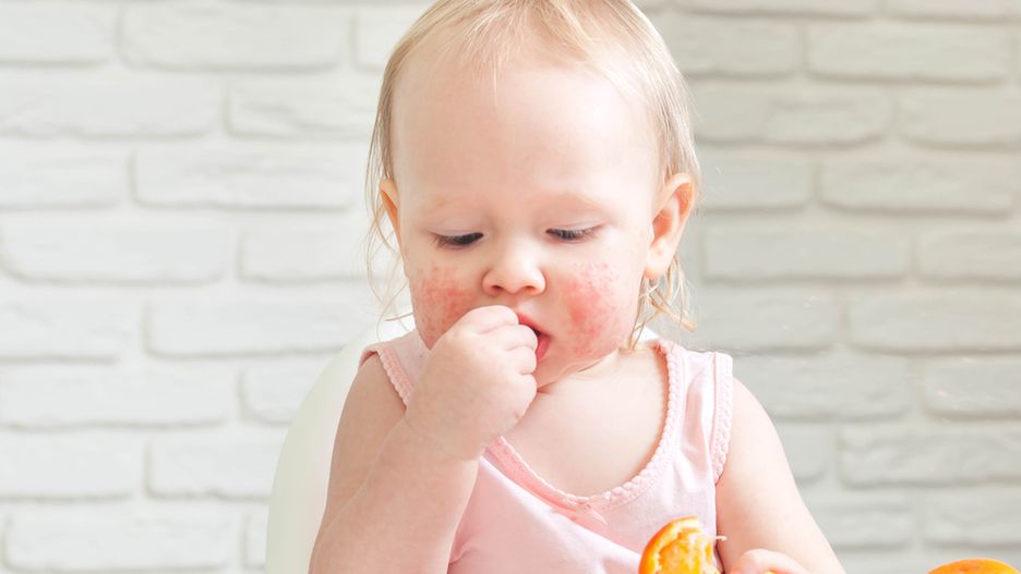 Objawy alergii pokarmowej u niemowlaka – sprawdź, jak je rozpoznać