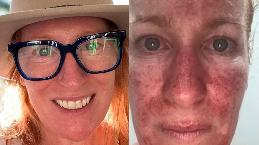 Tak wygląda rak skóry