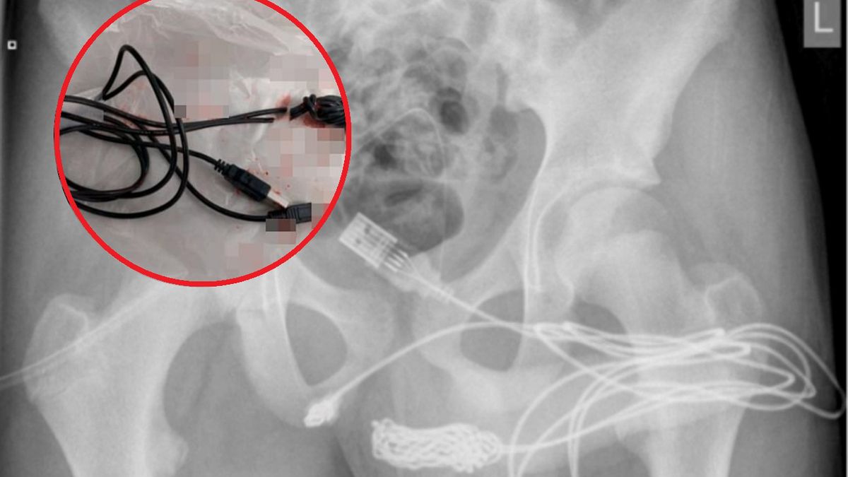 Nastolatek przeszedł operację, po tym jak wsadził kabel do swojego penisa