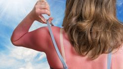 Oparzenia słoneczne - rodzaje, objawy, pierwsza pomoc, leczenie