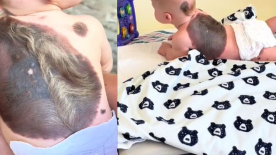 Ma trzy miesiące i spore grono fanów. Wszystko przez nietypowe znamię na plecach i głowie