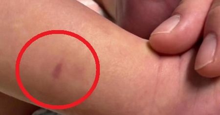 Zobaczyła ślad na nodze córki. Ta choroba może zabić w kilka godzin