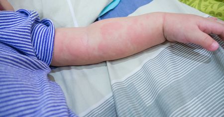 Świerzb u niemowląt – przyczyny, objawy i leczenie