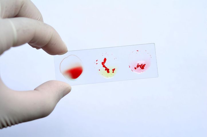 Aglutenacja to metoda stosowana do określenia grupy krwi. 
