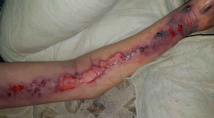 Martwicze zapalenie powęzi