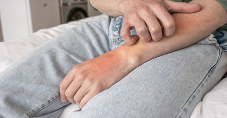 Pospolita jak rak, śmiertelna jak zawał. Objaw zauważysz na skórze