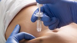 "Lepka krew" u pacjentów z COVID-19. Zatory, zawały i udary głównymi wczesnymi powikłaniami po zakażeniu koronawirusem