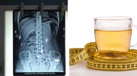 Dziewczyna przez trzy lata piła herbatki odchudzające. Po ich odstawieniu trafiła do szpitala