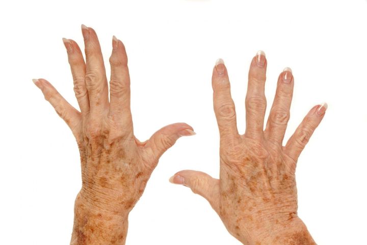 Plamy wątrobowe często pojawiają się na dłoniach i dekolcie.