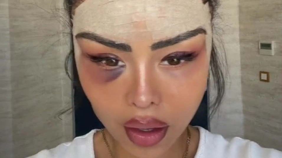 Zrobiła sobie foxy eyes w Turcji. Niektórzy uważają, że po zabiegu wygląda groteskowo i nienaturalnie