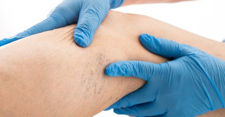 Diagnostyka zakrzepicy – objawy, D-dimery, badania dodatkowe