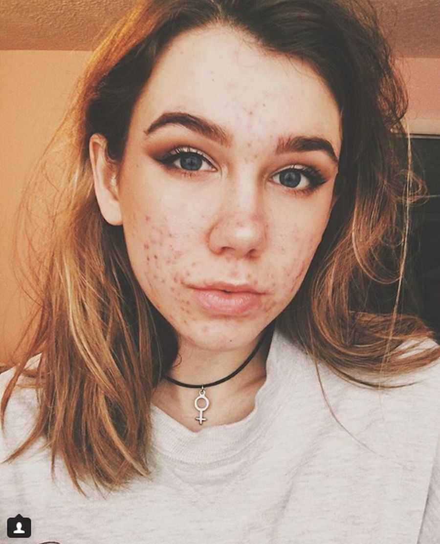 Emma mogła stracić wzrok przez stosowanie leku na trądzik