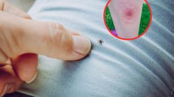 Kleszcze wywołują boreliozę. By się ochronić, koniecznie zrób to po spacerze