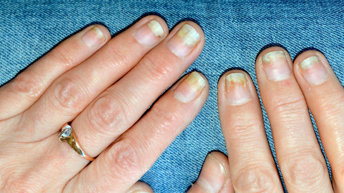 Łuszczyca paznokci może prowadzić do zniszczenia płytki paznokciowej