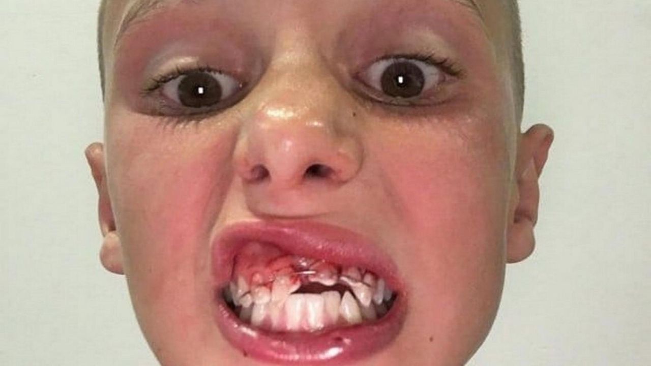 Groźny wypadek na basenie. Lekarzom udało się uratować uśmiech chłopca