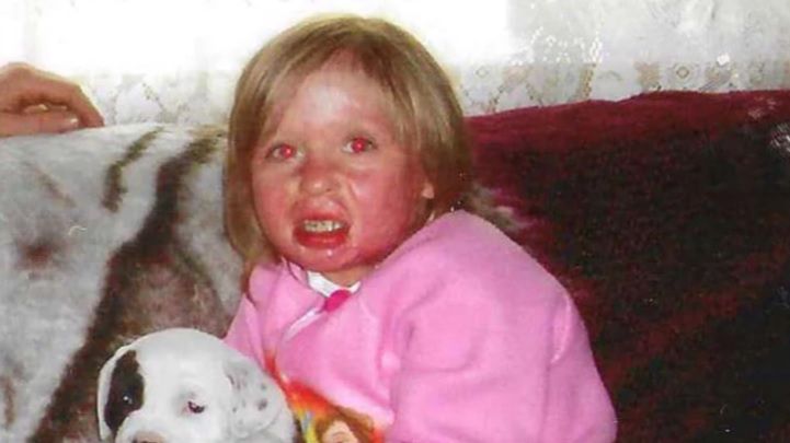 Matka chciała pozbyć się wszy z głowy dziecka. Użyła do tego benzyny