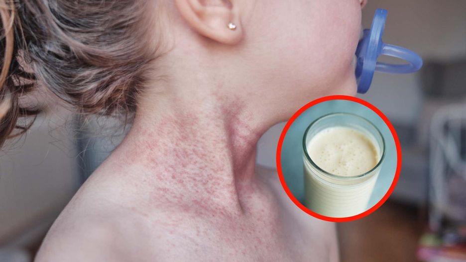 Mleko to najczęstszy alergen u wszystkich dzieci