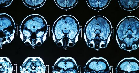 Parkinsonizm młodzieńczy dotyka osób poniżej 20 roku życia. Zobacz czym się objawia