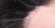 Swędząca skóra głowy – przyczyny, objawy i leczenie
