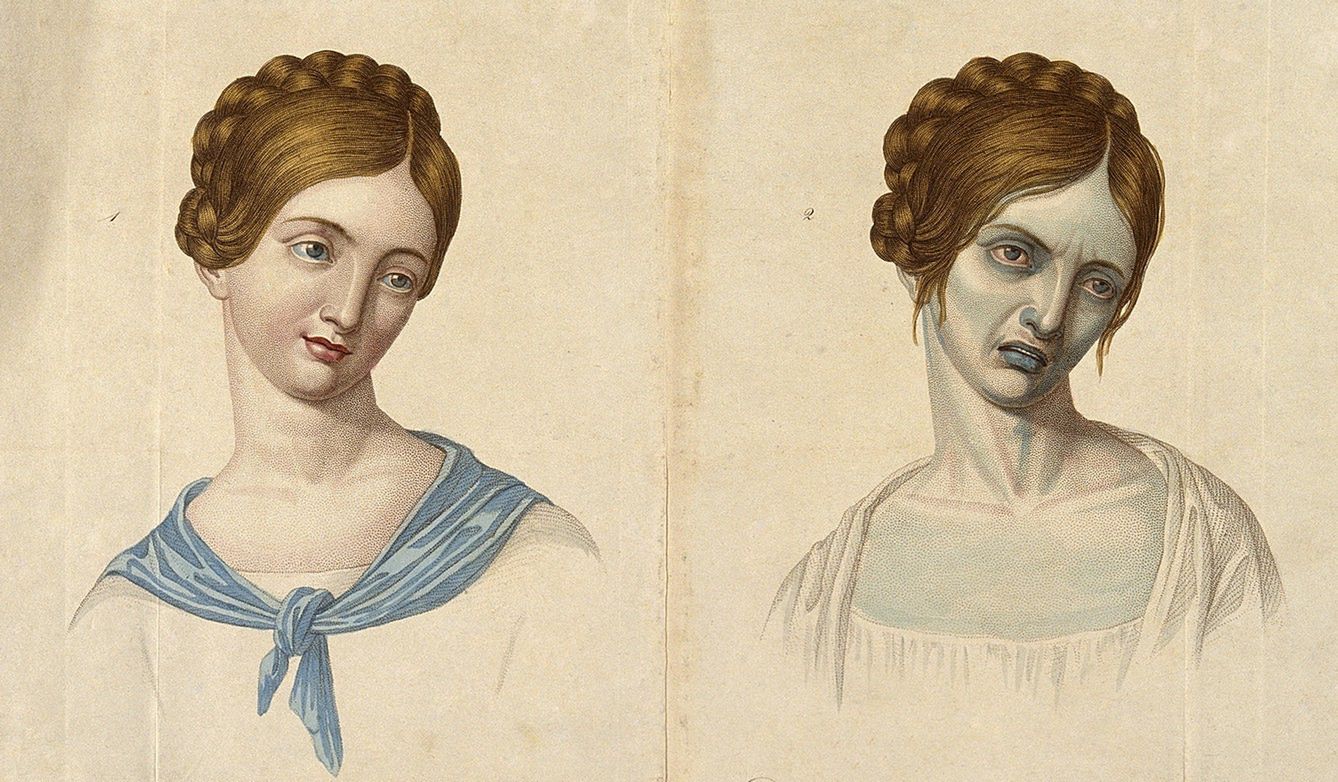 Ofiara cholery przed i po zarażeniu 