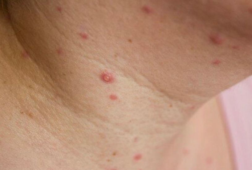 Zmiany pęcherzykowe COVID-19