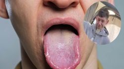 Zranił się podczas gryzienia. Nie przypuszczał, że wkrótce straci język