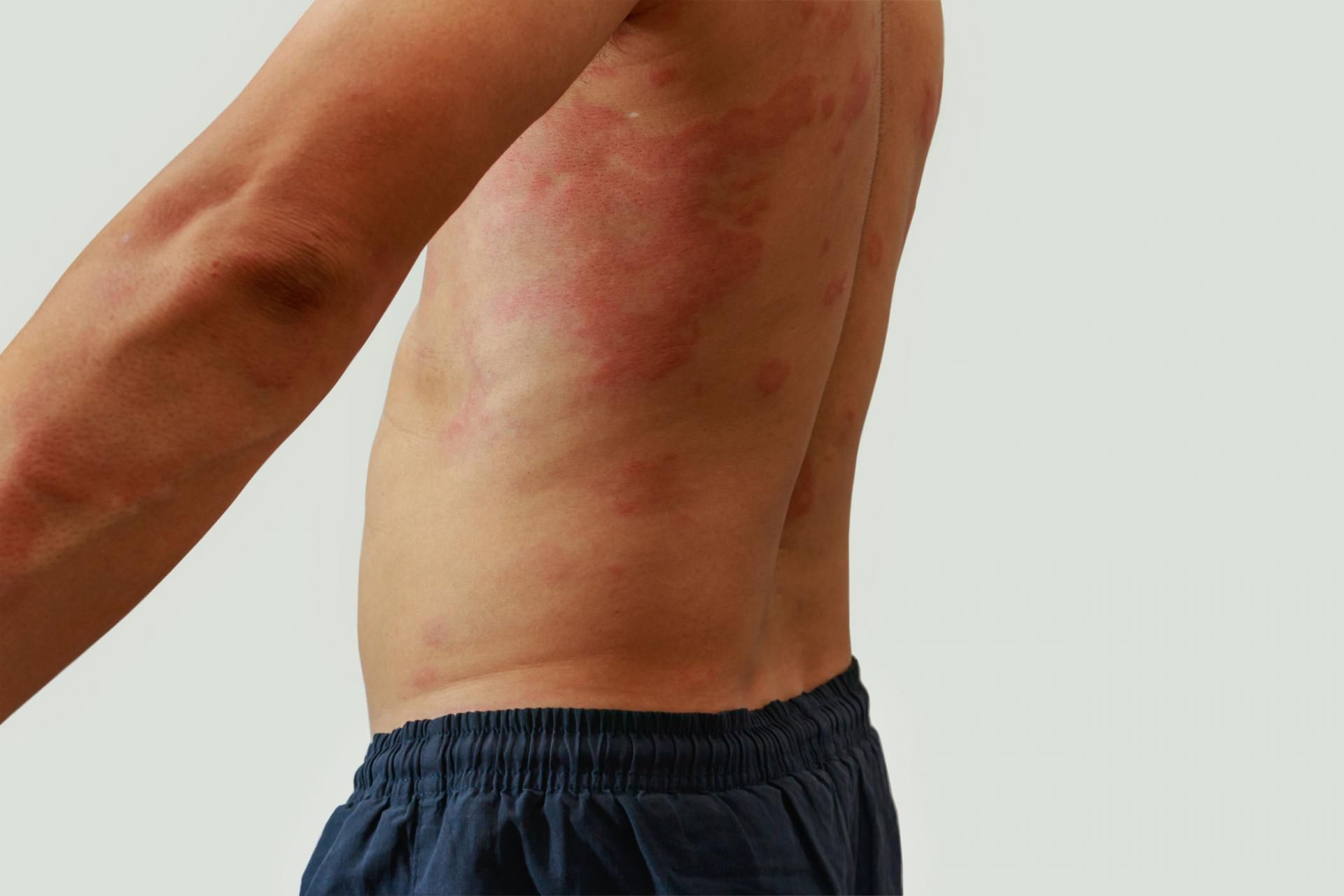 Atopowe zapalenie skóry jest nieuleczalne