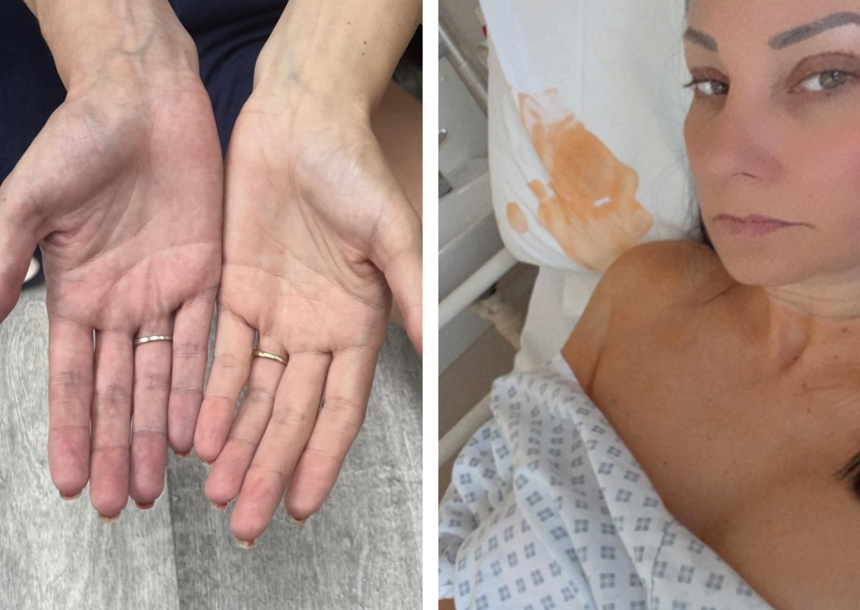 44-latka ma problemy z krążeniem przez co sinieją jej ręce