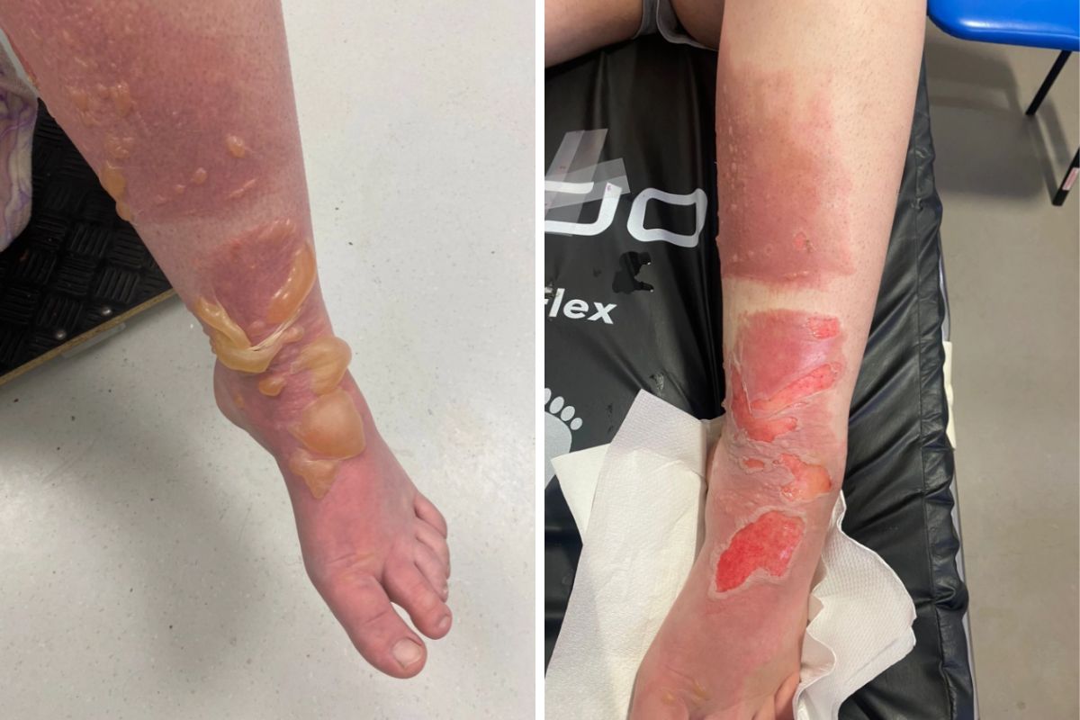 Oparzenia były poważne - 18-latka wciąż cierpi z bólu