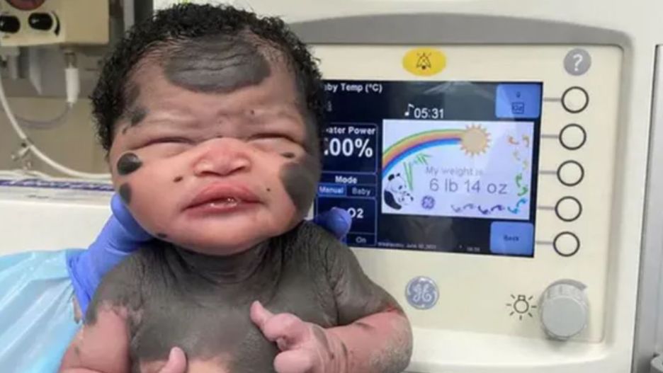 "Dziewczynka panda" ma już 3 lata. Wygląda abolutnie wyjątkowo