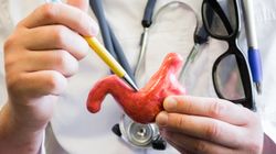 Choroba wrzodowa - przyczyny, helicobacter pylori, objawy, rozpoznanie, leczenie, powikłania, leczenie operacyjne, rokowanie