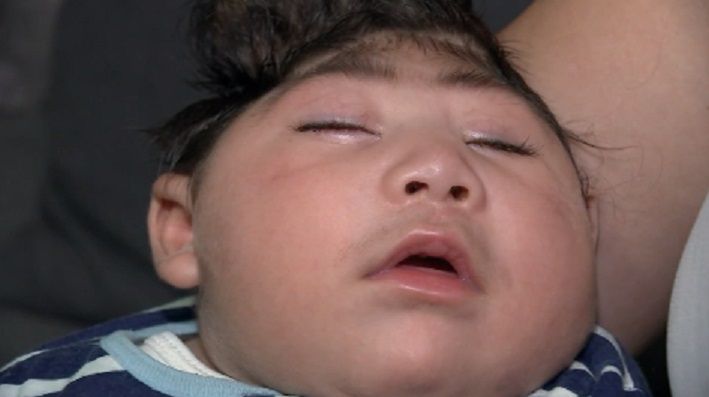 Dziecko z połową czaszki. Lucas Santa Maria to pierwszy chłopiec, który żyje bez czaszki