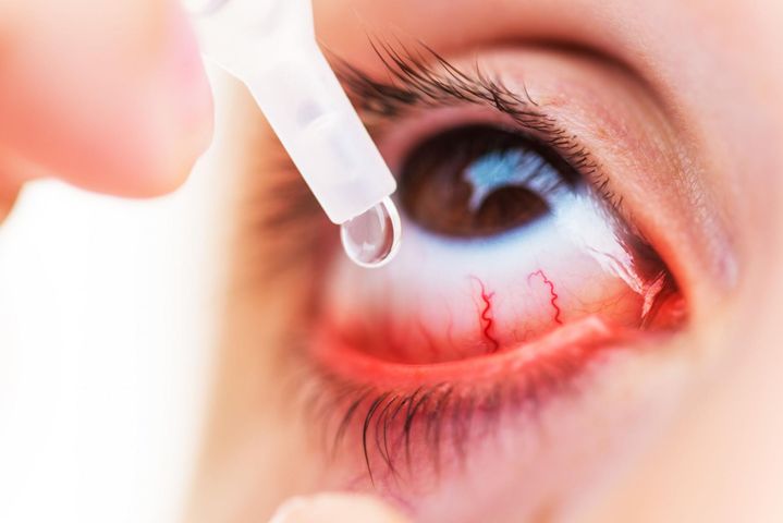 Krople do oczu dla alergików i na nadciśnienie znikają z aptek