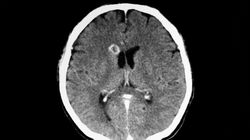 Ropień mózgu - przyczyny, objawy i leczenie