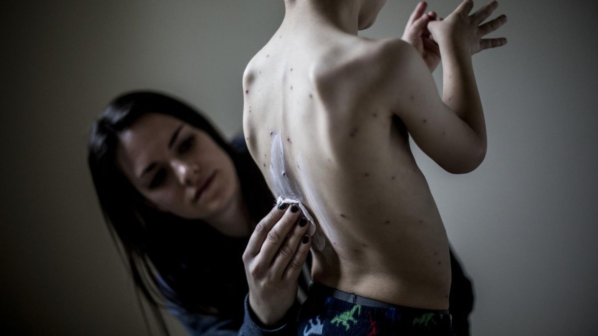 Ospa wietrzna objawia się krostkami rozsianymi po całym ciele chorego.